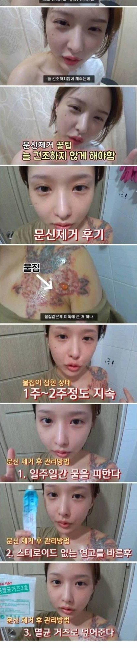어느 유튜버의 타투제거 후기