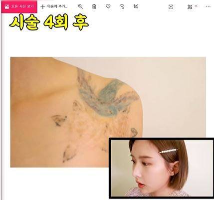 어느 유튜버의 타투제거 후기