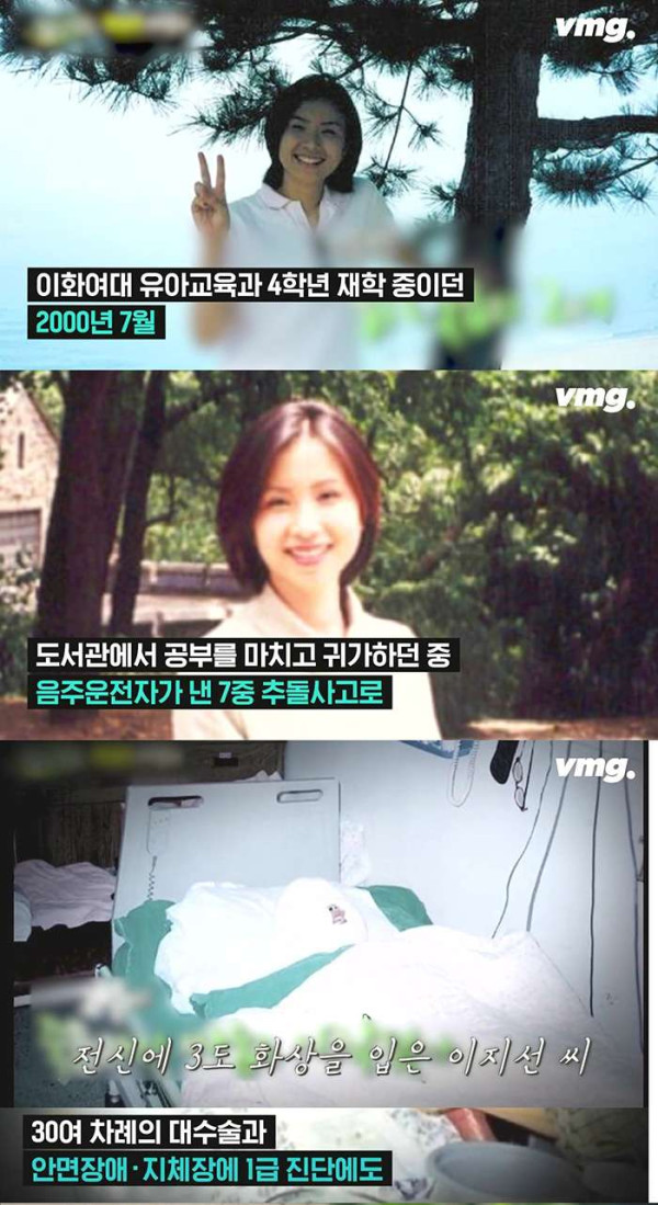 음주운전 사고로 전신화상을 입은 대학생 근황