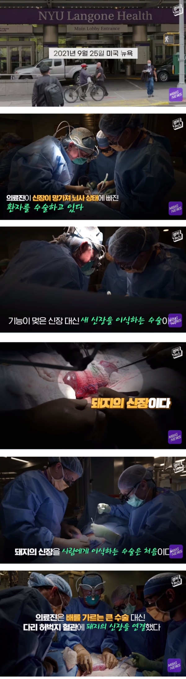 세계 최초 돼지 신장 사람에게 이식 성공
