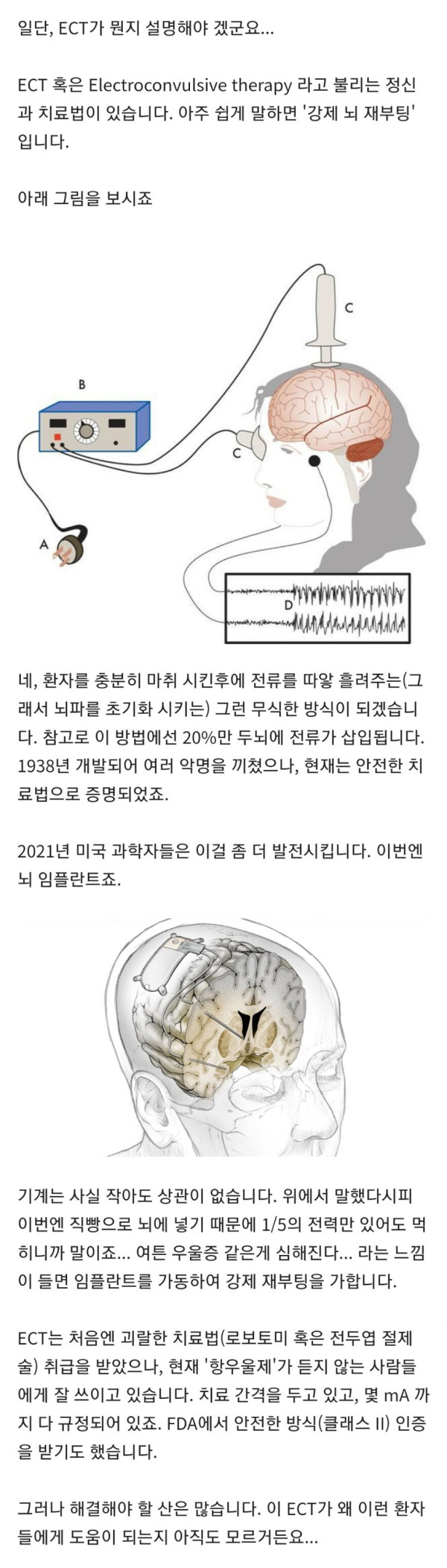 뇌를 강제 재부팅하는 우울증 치료법