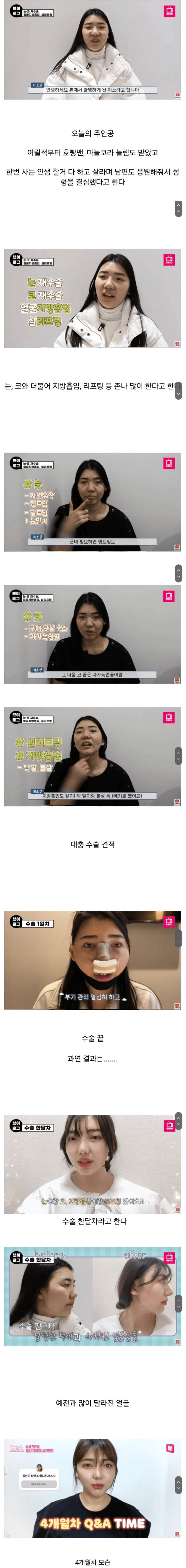 한국에서 성형 수술 받고 간 일본녀