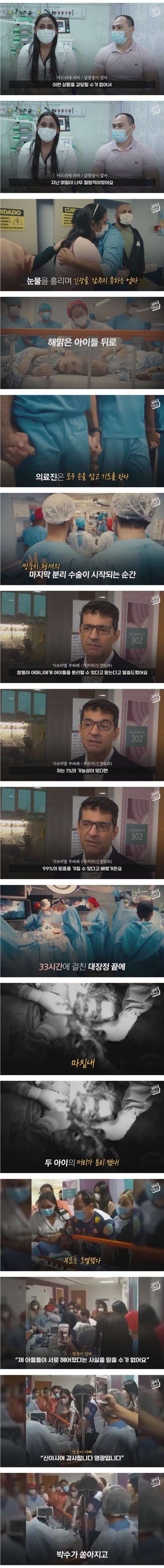 33시간 수술 끝에 헤어진 두 아들