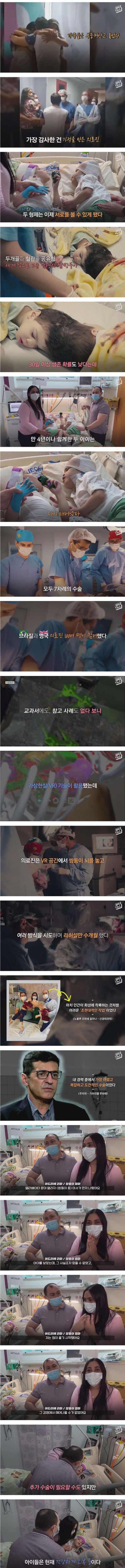 33시간 수술 끝에 헤어진 두 아들