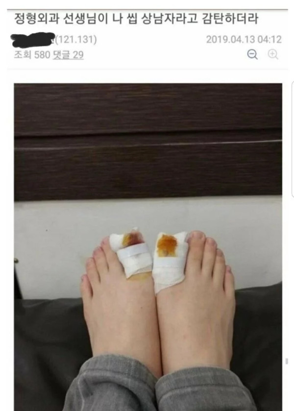 정형외과에서 마취도 없이 생으로 발톱 뽑은 썰